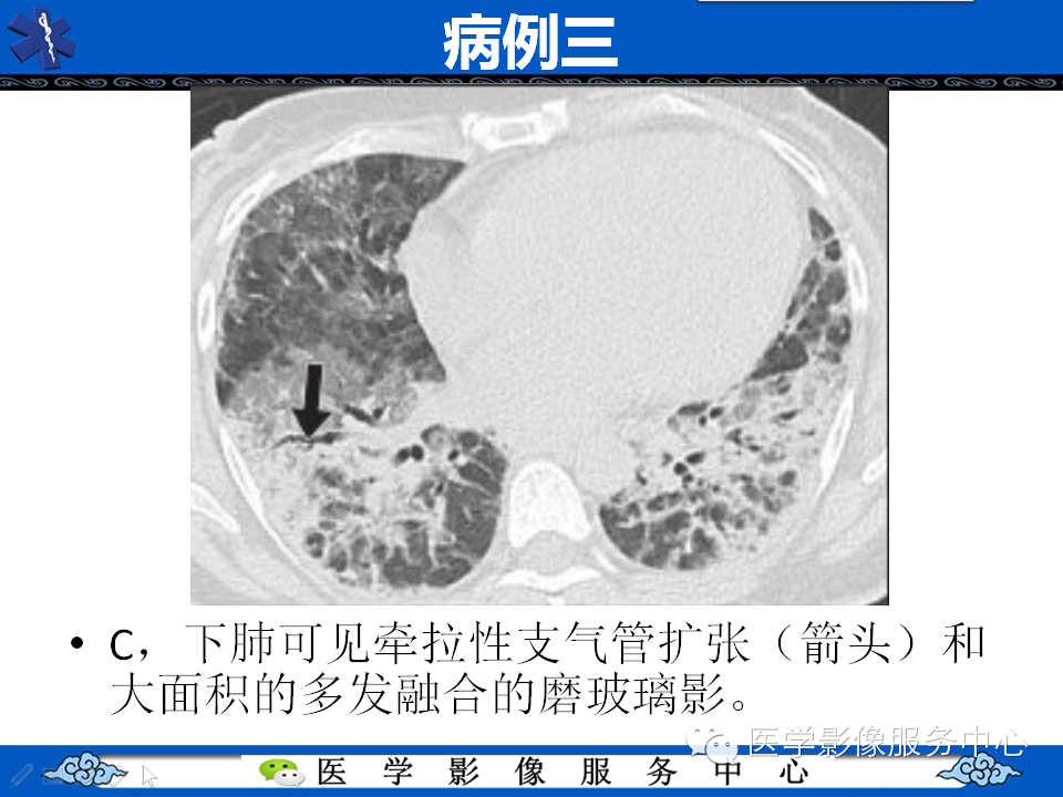 中东呼吸综合征的影像学表现