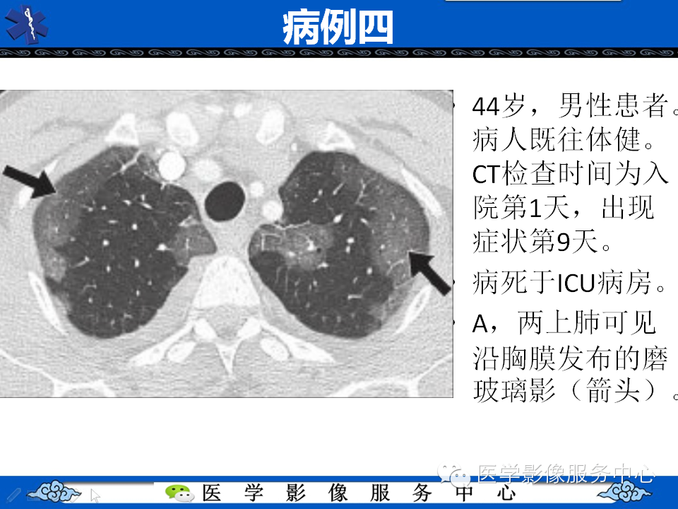 中东呼吸综合征的影像学表现