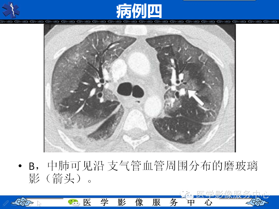 中东呼吸综合征的影像学表现