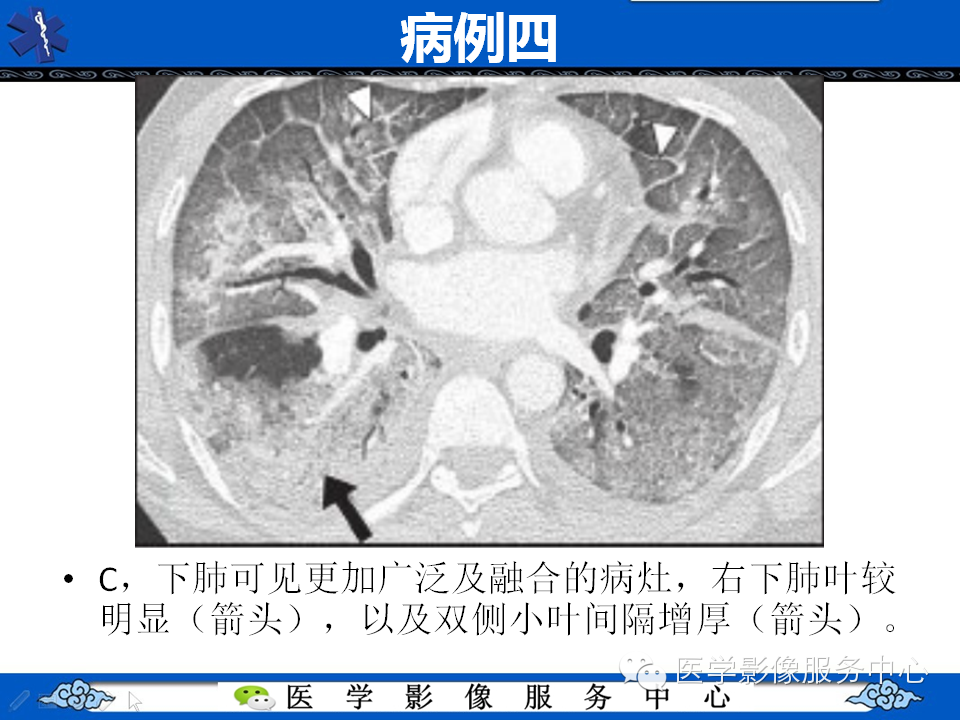 中东呼吸综合征的影像学表现