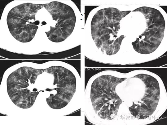 【病例学习】肺脂肪栓塞综合征一例CT诊断