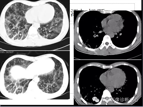【病例学习】肺脂肪栓塞综合征一例CT诊断