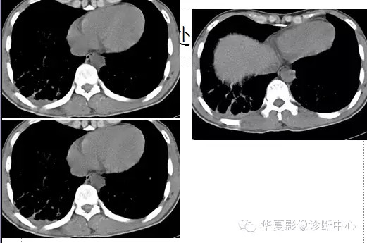 【病例学习】肺脂肪栓塞综合征一例CT诊断