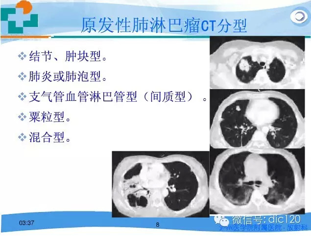 肺淋巴瘤的影像诊断