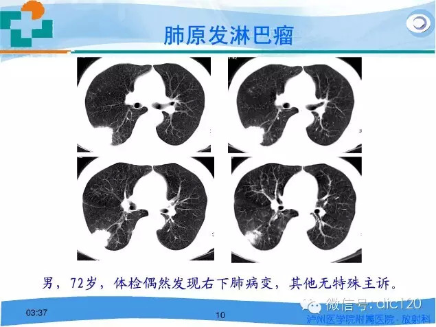 肺淋巴瘤的影像诊断