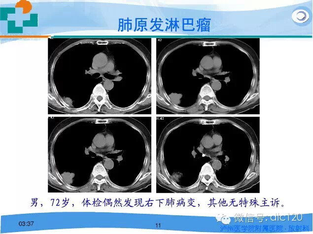 肺淋巴瘤的影像诊断
