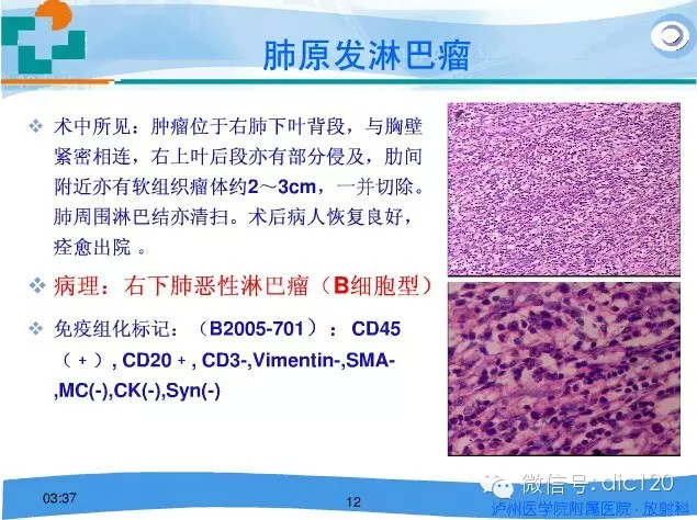 肺淋巴瘤的影像诊断