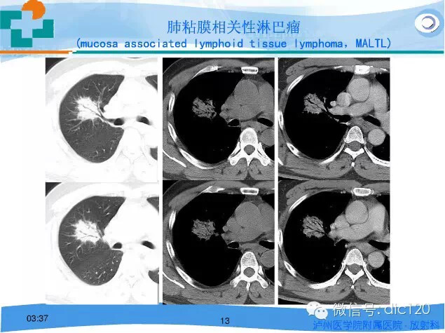 肺淋巴瘤的影像诊断