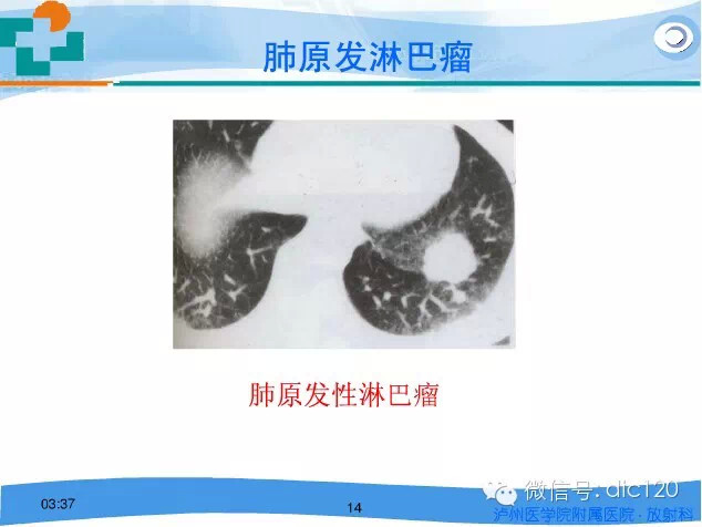 肺淋巴瘤的影像诊断