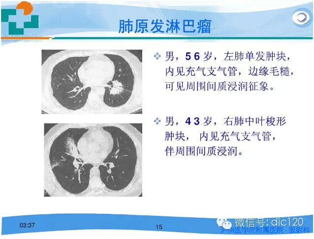 肺淋巴瘤的影像诊断
