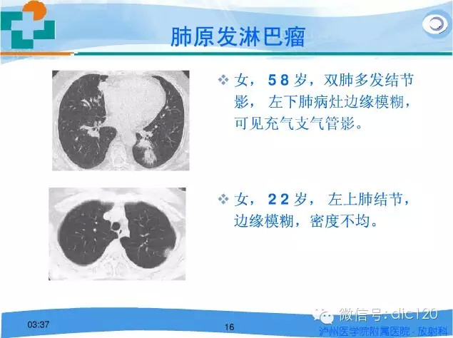 肺淋巴瘤的影像诊断