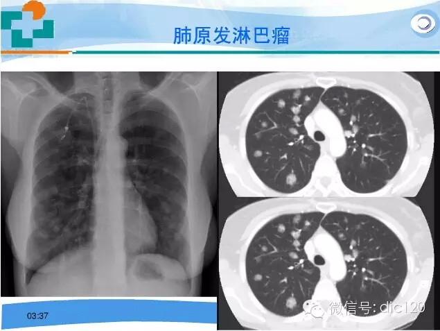 肺淋巴瘤的影像诊断