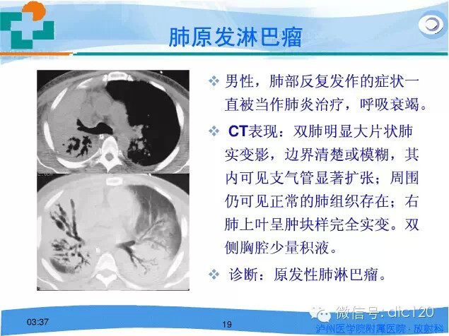 肺淋巴瘤的影像诊断