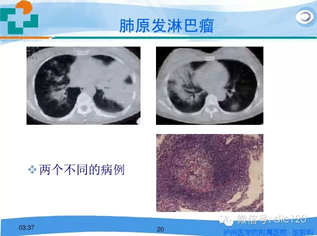 肺淋巴瘤的影像诊断