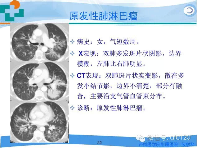 肺淋巴瘤的影像诊断