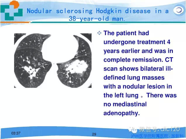 肺淋巴瘤的影像诊断