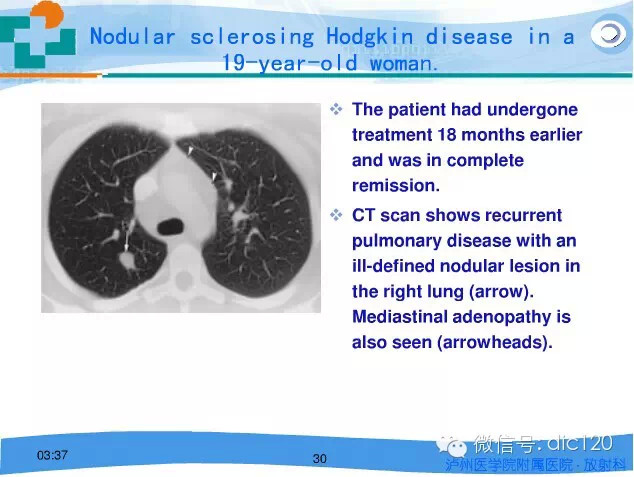 肺淋巴瘤的影像诊断