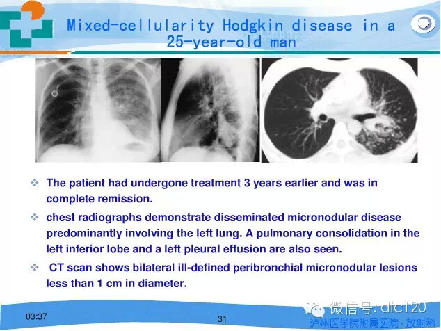肺淋巴瘤的影像诊断
