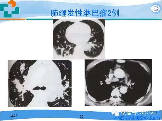 肺淋巴瘤的影像诊断