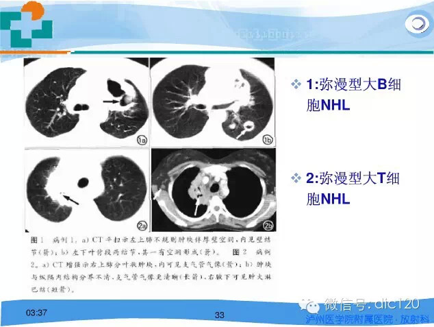 肺淋巴瘤的影像诊断