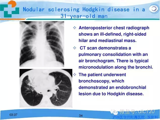 肺淋巴瘤的影像诊断