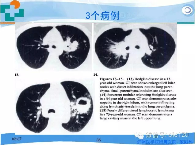 肺淋巴瘤的影像诊断
