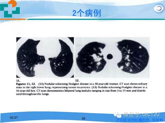 肺淋巴瘤的影像诊断