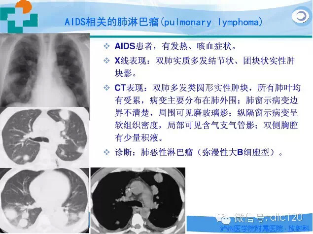 肺淋巴瘤的影像诊断