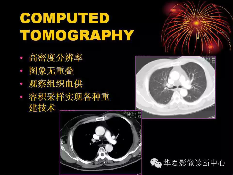 肺与纵隔的影像诊断