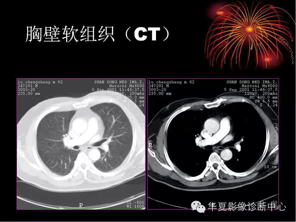 肺与纵隔的影像诊断