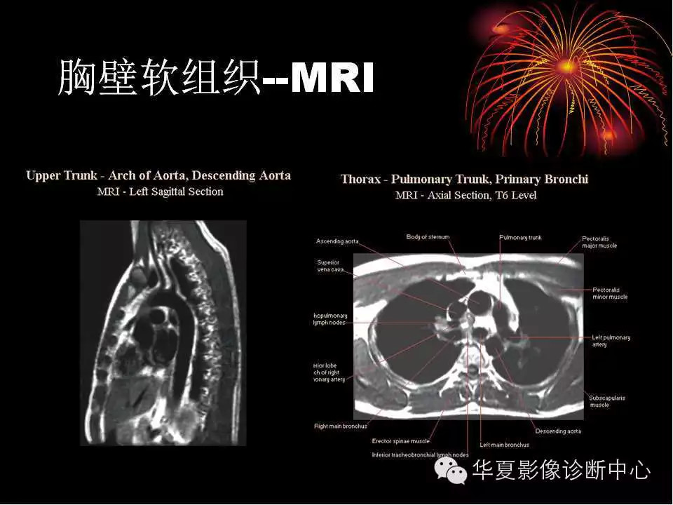 肺与纵隔的影像诊断