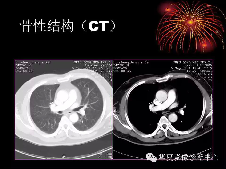 肺与纵隔的影像诊断