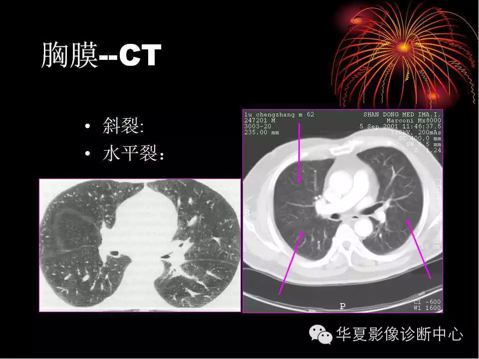 肺与纵隔的影像诊断