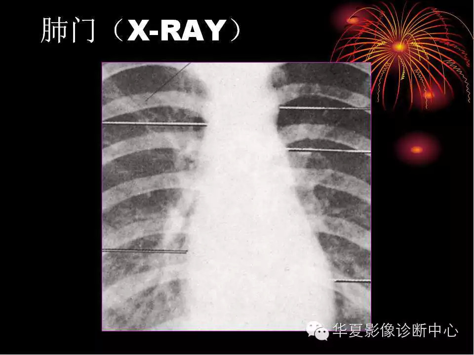 肺与纵隔的影像诊断