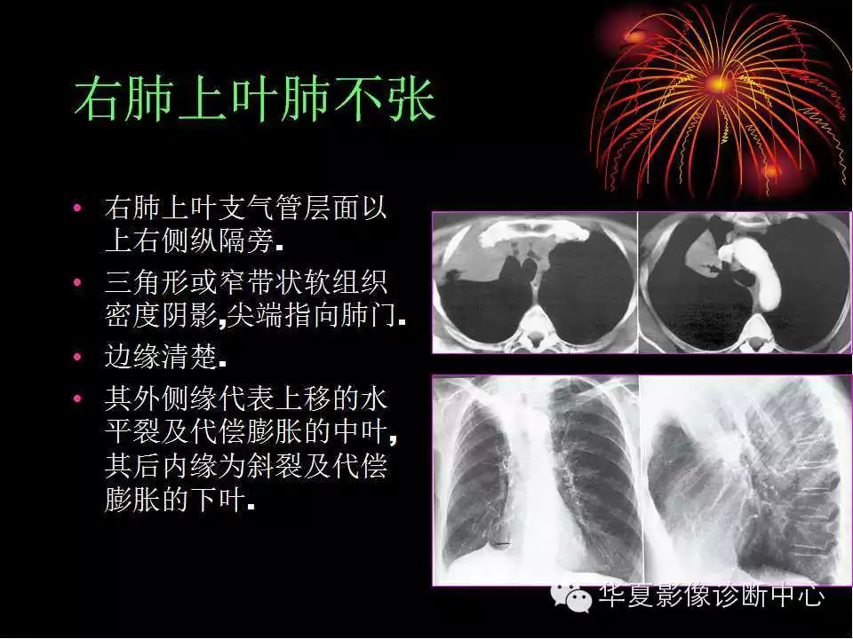 肺与纵隔的影像诊断