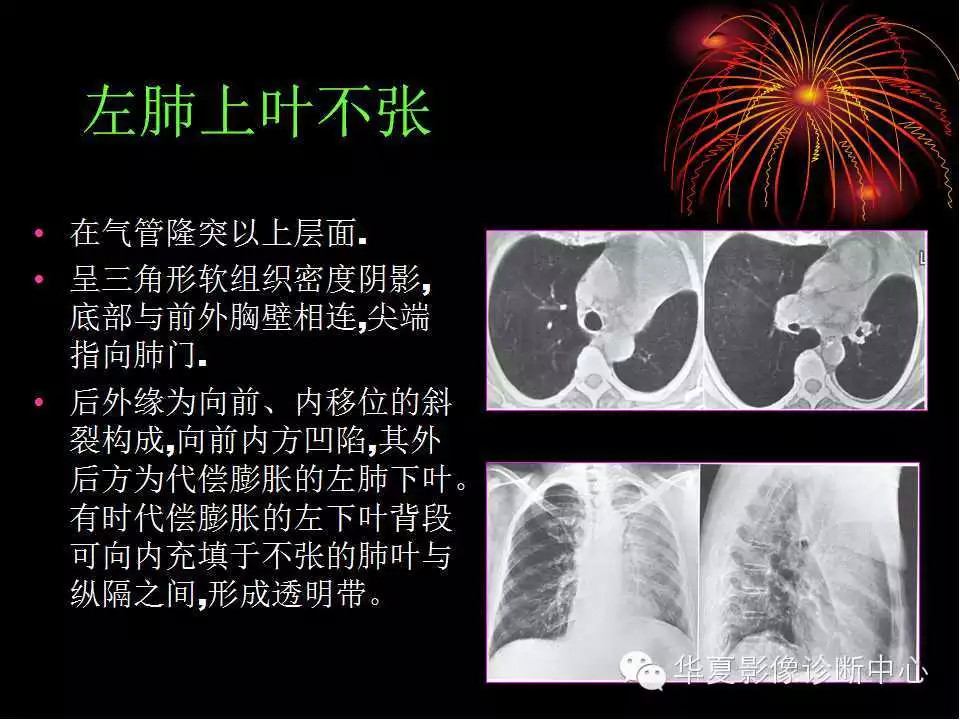 肺与纵隔的影像诊断