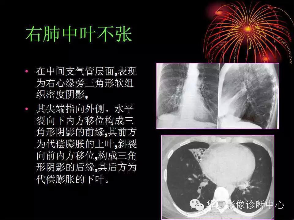 肺与纵隔的影像诊断