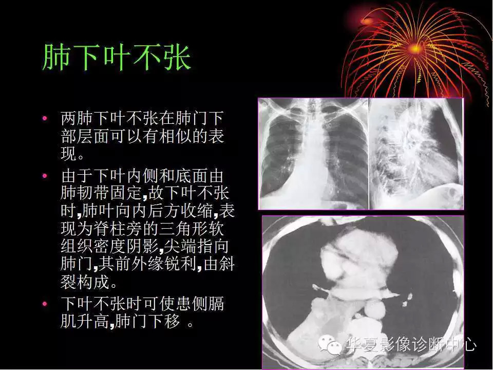 肺与纵隔的影像诊断