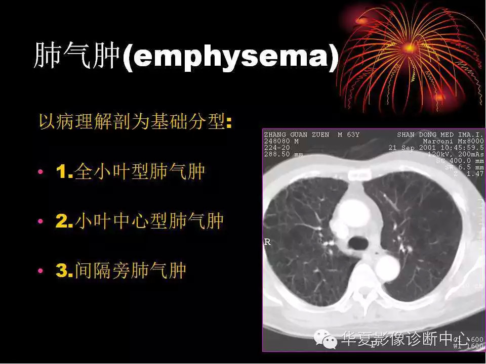 肺与纵隔的影像诊断