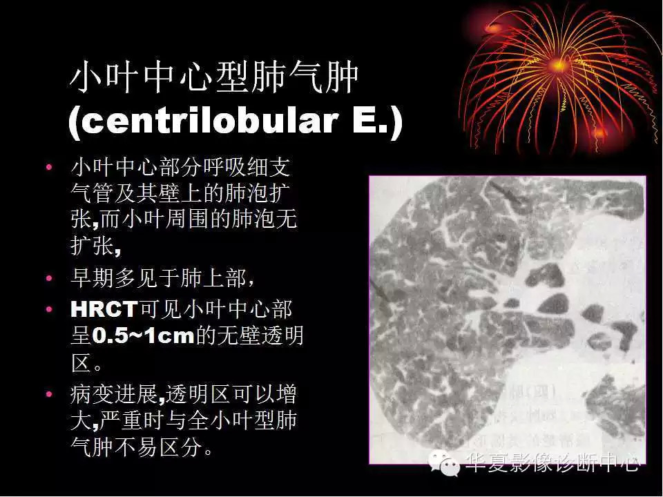 肺与纵隔的影像诊断