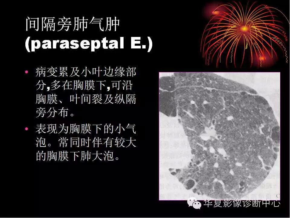 肺与纵隔的影像诊断