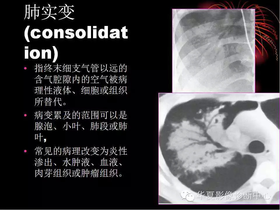 肺与纵隔的影像诊断