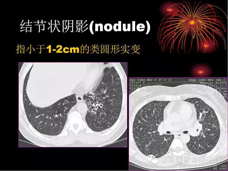 肺与纵隔的影像诊断