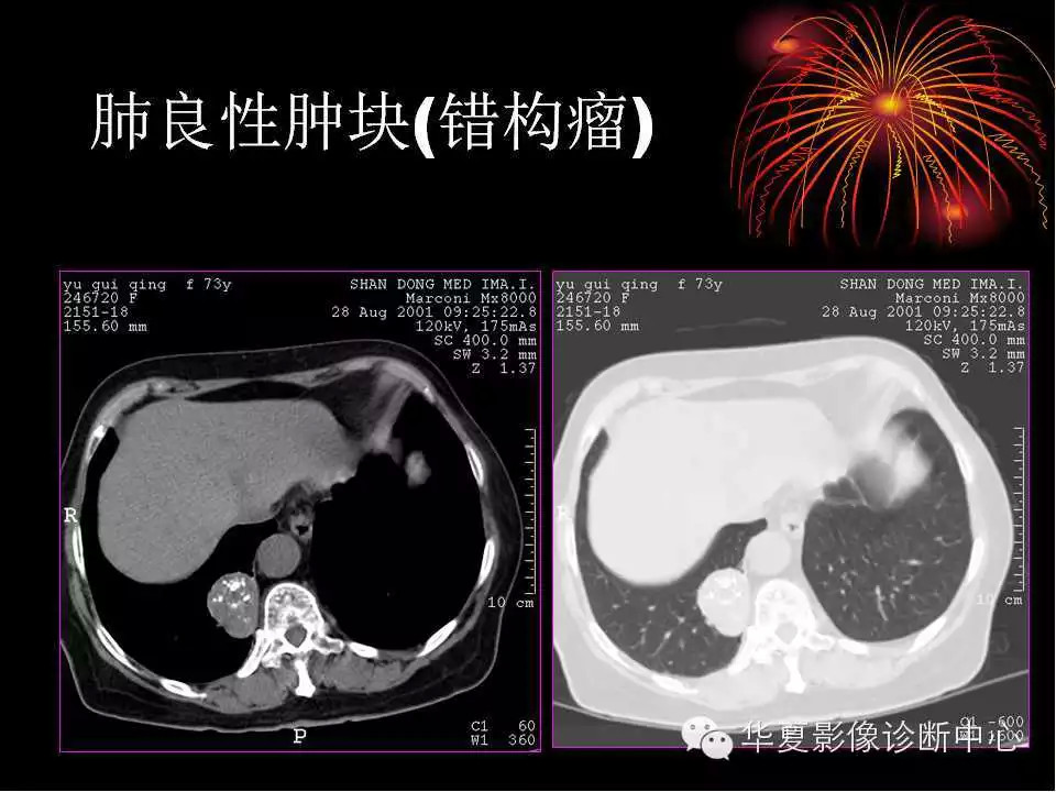 肺与纵隔的影像诊断
