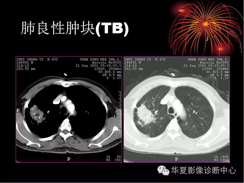 肺与纵隔的影像诊断