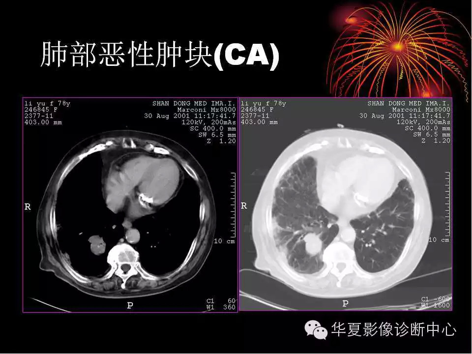 肺与纵隔的影像诊断