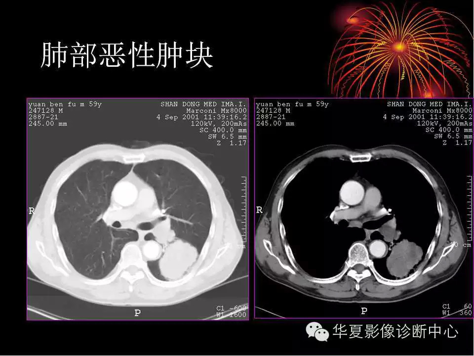 肺与纵隔的影像诊断