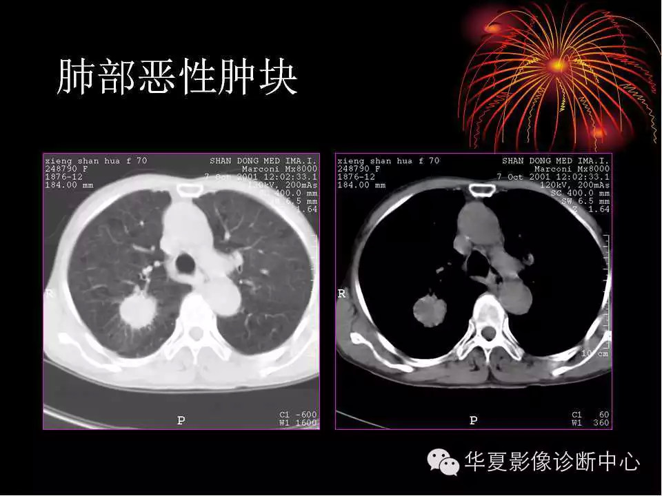 肺与纵隔的影像诊断