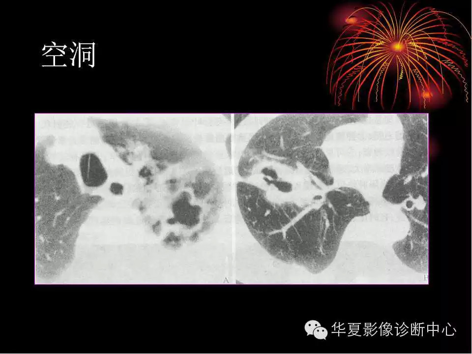 肺与纵隔的影像诊断