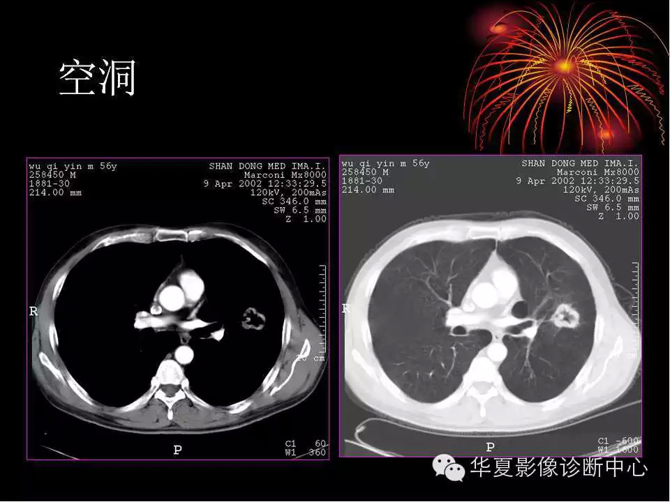 肺与纵隔的影像诊断